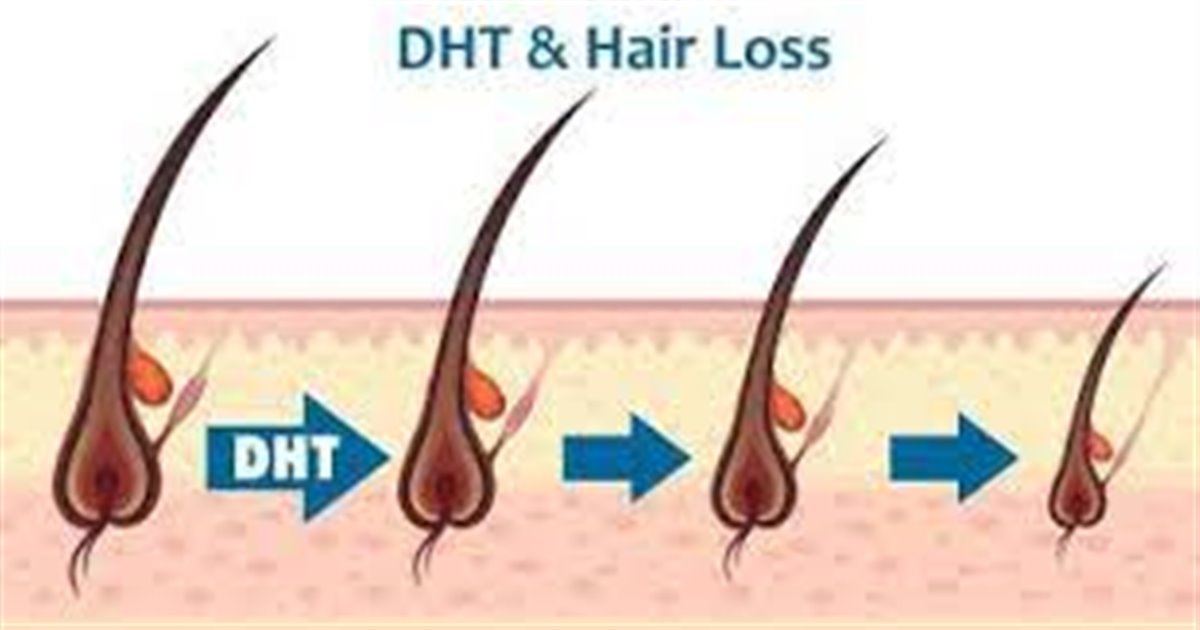 اهمیت هومون DHT و ارتباط آن با ریزش مو
