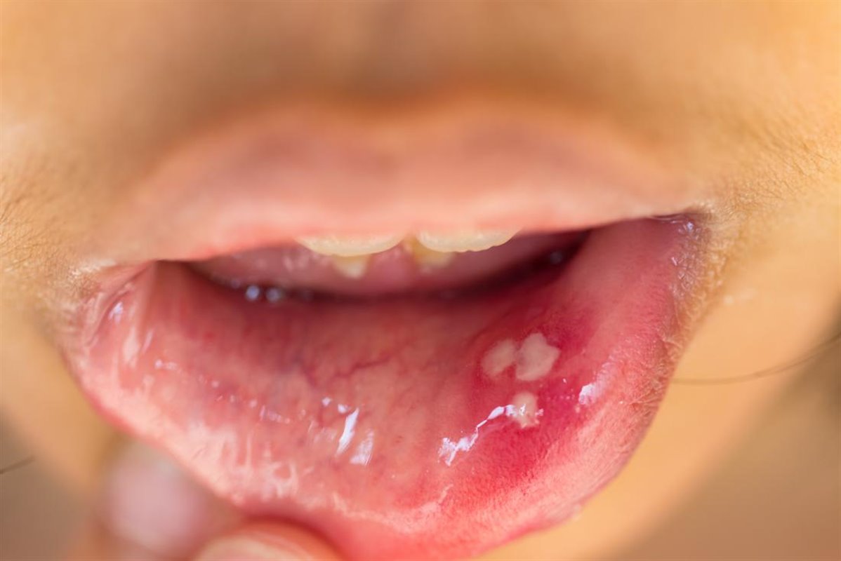 زگیل دهانی و گسترش آن